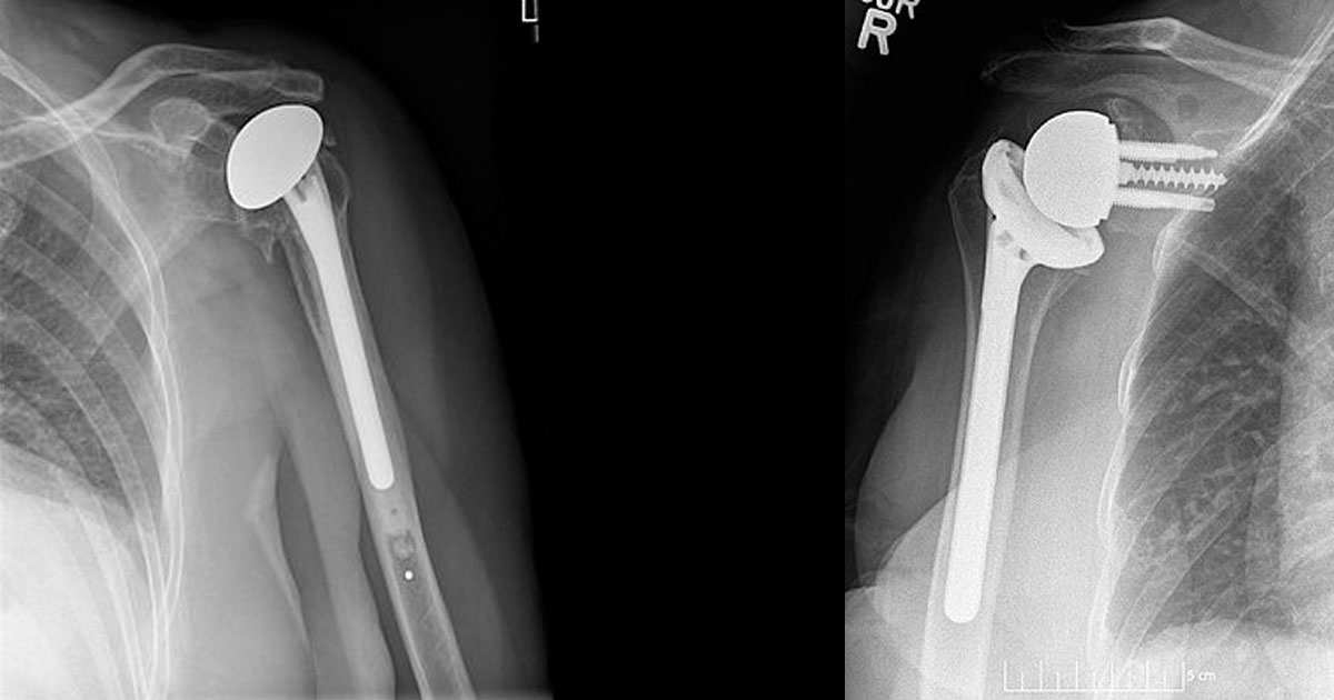 Total Shoulder Arthroplasty 9159